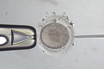 IMSI Treatment in india