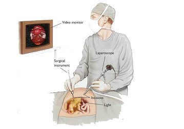 Laparoscopy in India