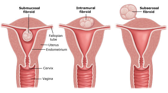Fibroids and Infertility