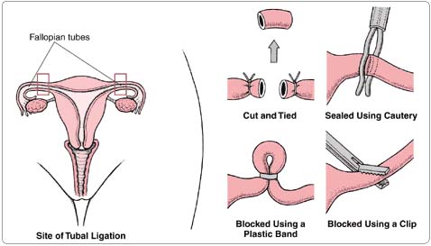 tubal ligation