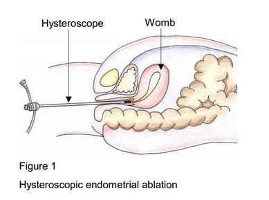 Hysteroscopy Surgery in India