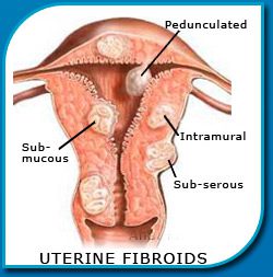 Fibroid Treatment in India