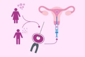 Gestational Surrogacy Process