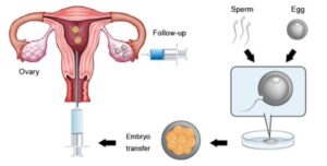 Step By Step IVF Process