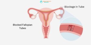 Blocked Fallopian Tubes