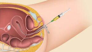 Is Egg Donation Painful