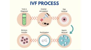 Stage Of IVF Treatment in Dubai