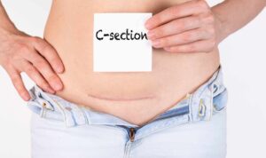 c section