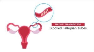 Fertility Treatment For Blockage Fallopian Tube