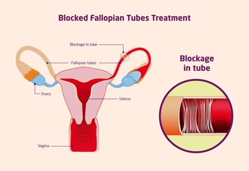 Fertility Treatments For Blocked Fallopian Tubes