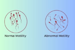 Male Sperm Infertility Or Low Motility