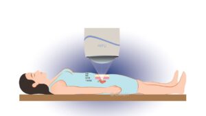 HIFU Treatment Fibroid From Uterus