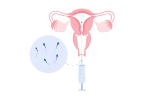 IUI Treatment Cost In Mumbai