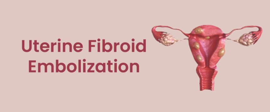 UFE Treatment For Fibroids In India