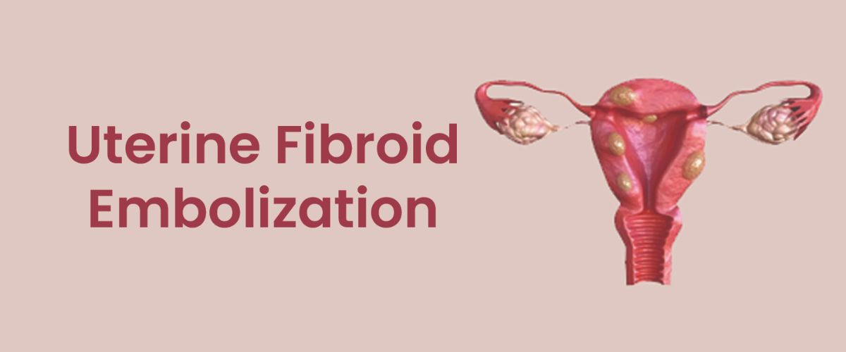 UFE Treatment For Fibroids In India