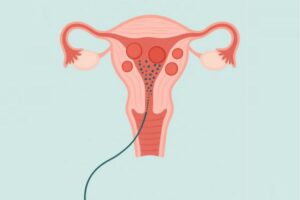 UFE Treatment In Delhi