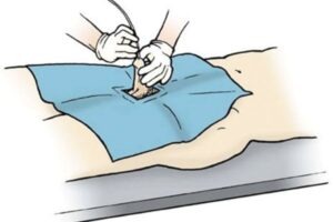 Varicocele For Male Infertility Treatment