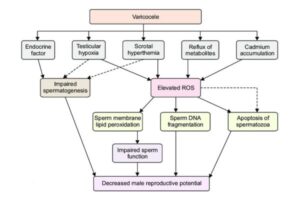 Varicocele Male Infertility Treatment