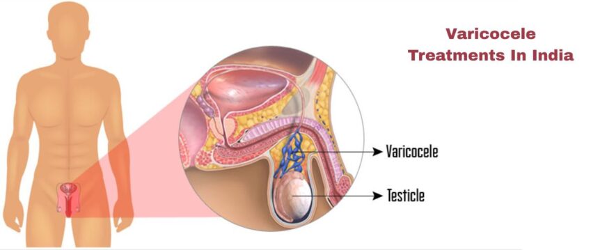 Varicocele Treatments In India
